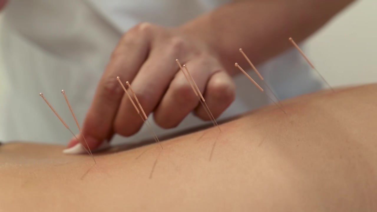 中医特写扎完针灸拔出银针